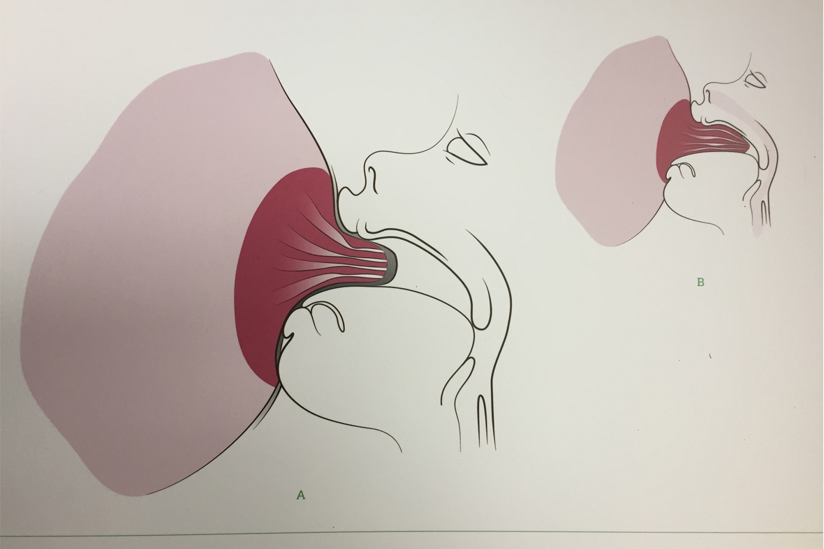 Utiliser des bouts de seins en silicone : un bien ou un mal pour l' allaitement ?